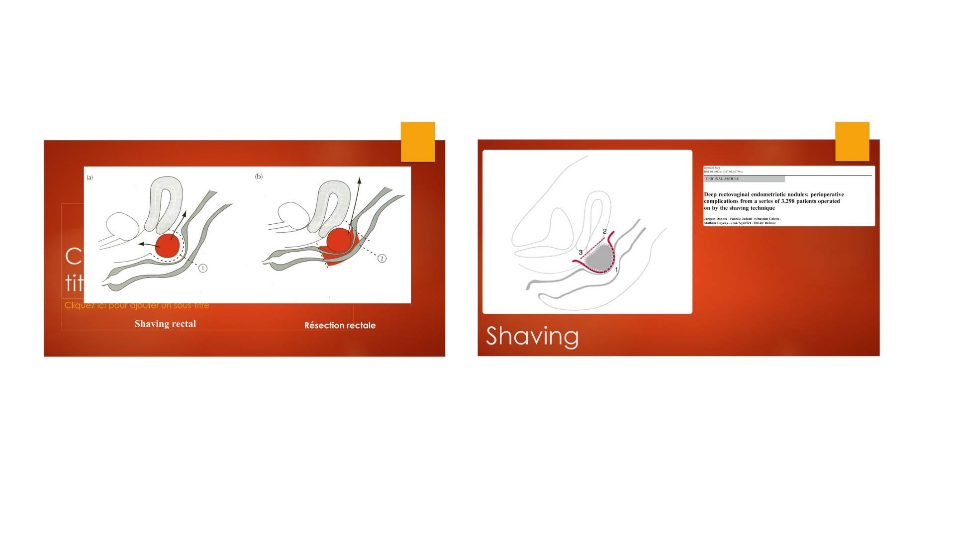 Endométriose profonde rectale