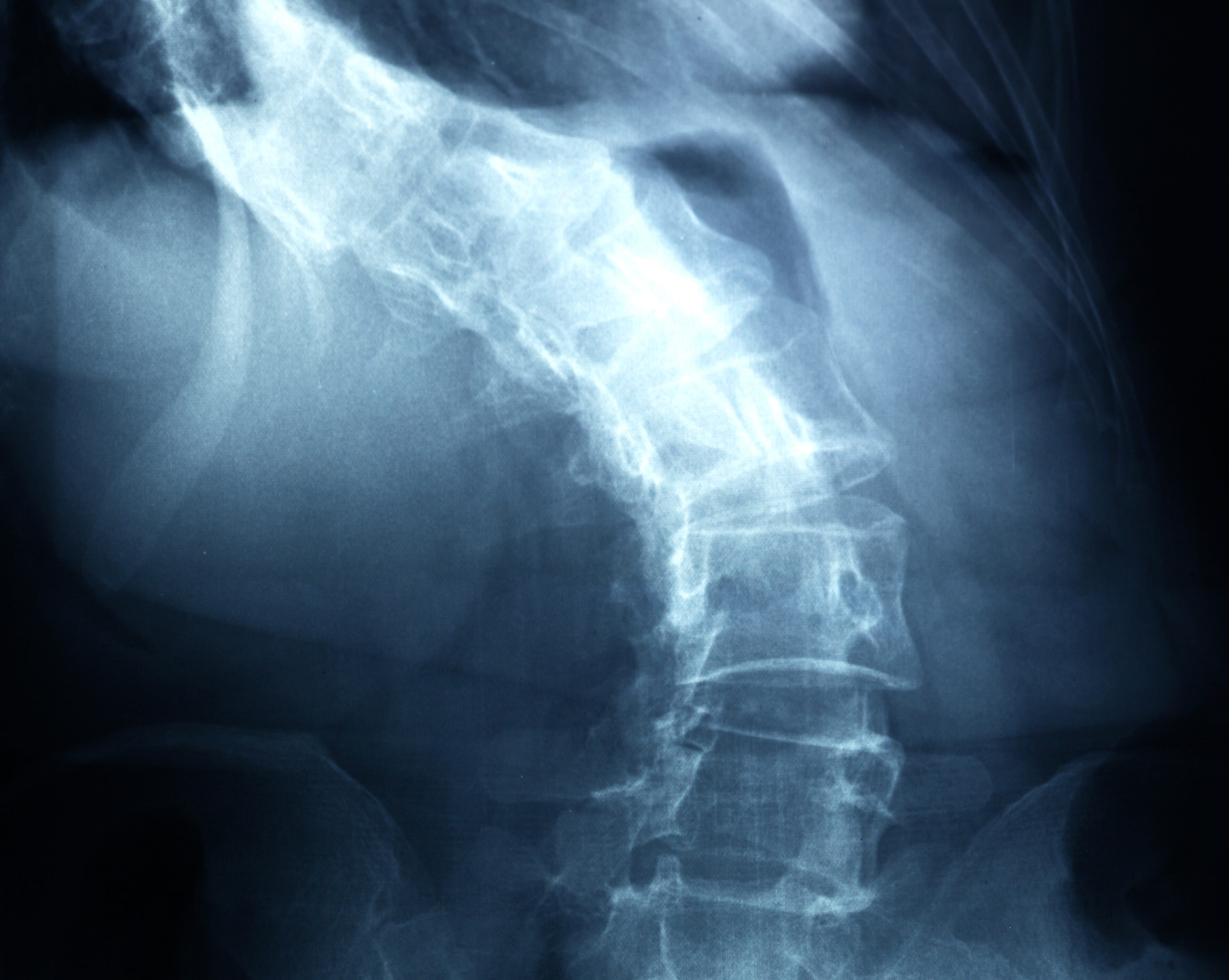 Image pour illustrer la Scoliose Idiopathique