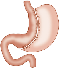 La sleeve gastrique