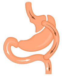 Le bypass gastrique