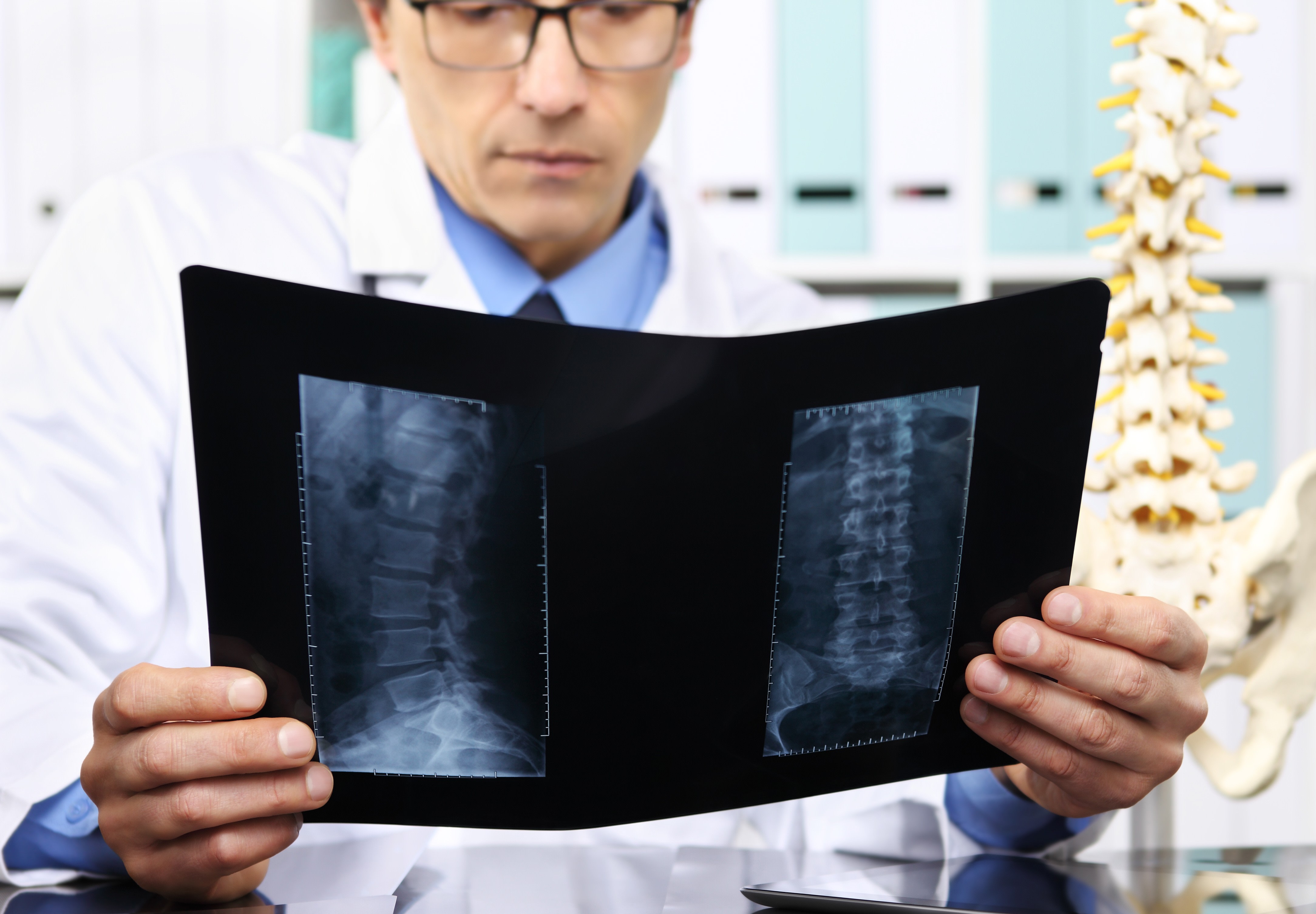 Image illustre l'Hernie Discale Lombaire