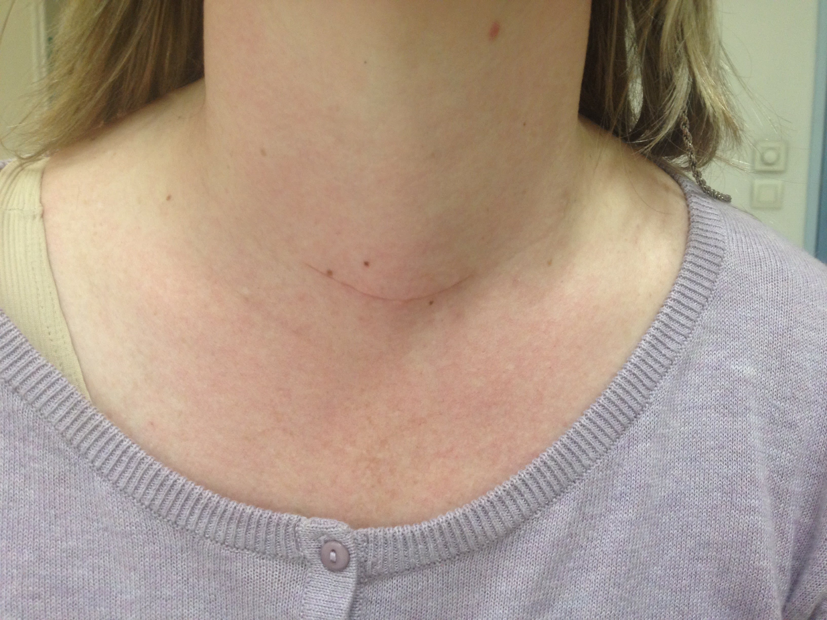 La glande thyroïde