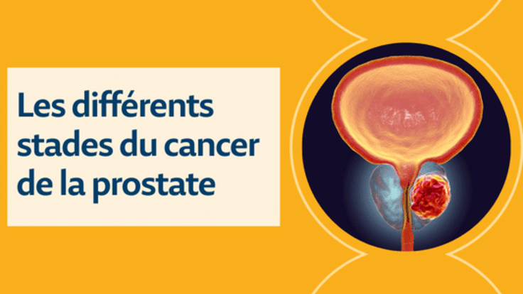 Stades Du Cancer De La Prostate Diagnostic Et Traitement 3052