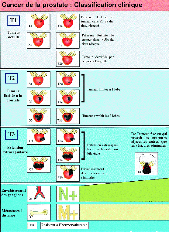 Classification Cancer Prostate