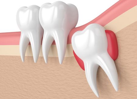 Extraction dent de sagesse  Clinique Dentaire Newport à Pantin