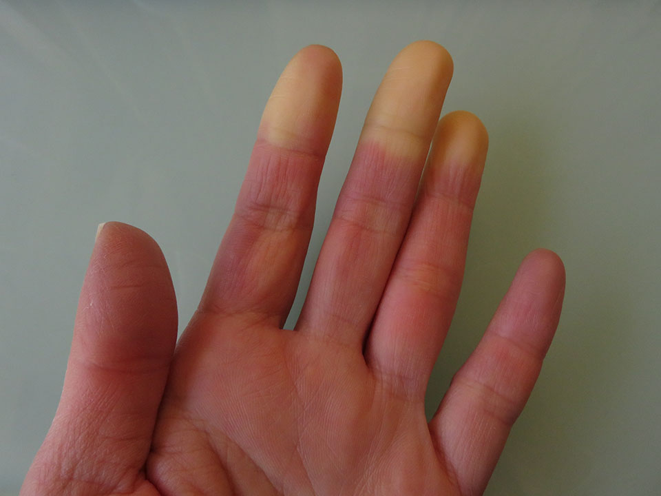 Maladie des doigts de la main et maladie du pouce