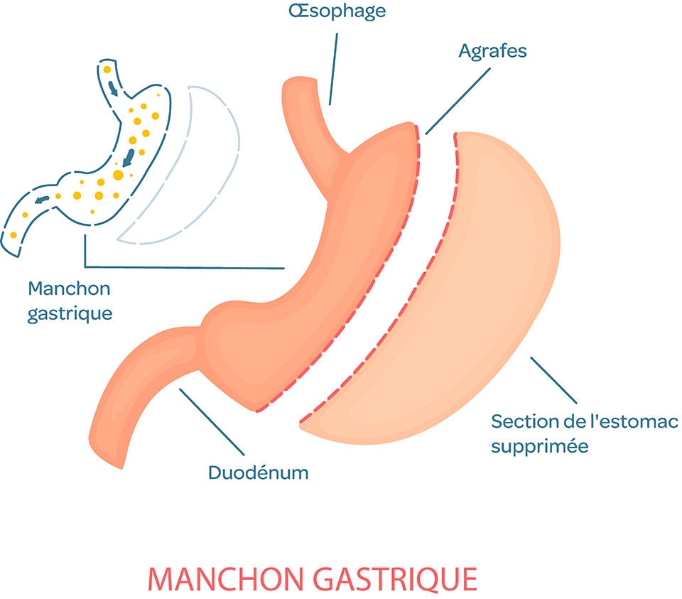 Sleeve gastrectomie - Guide complet sur la Sleeve