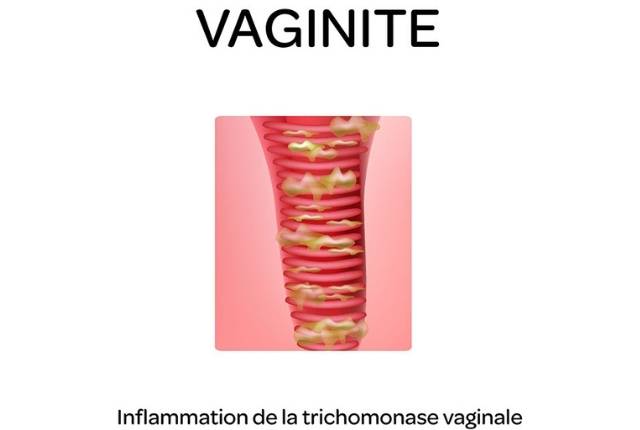 vaginite symptome