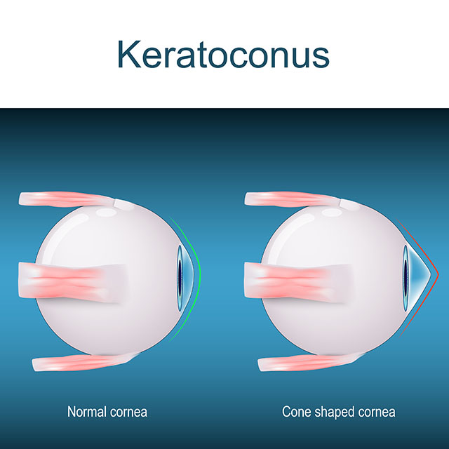 keratocone schema