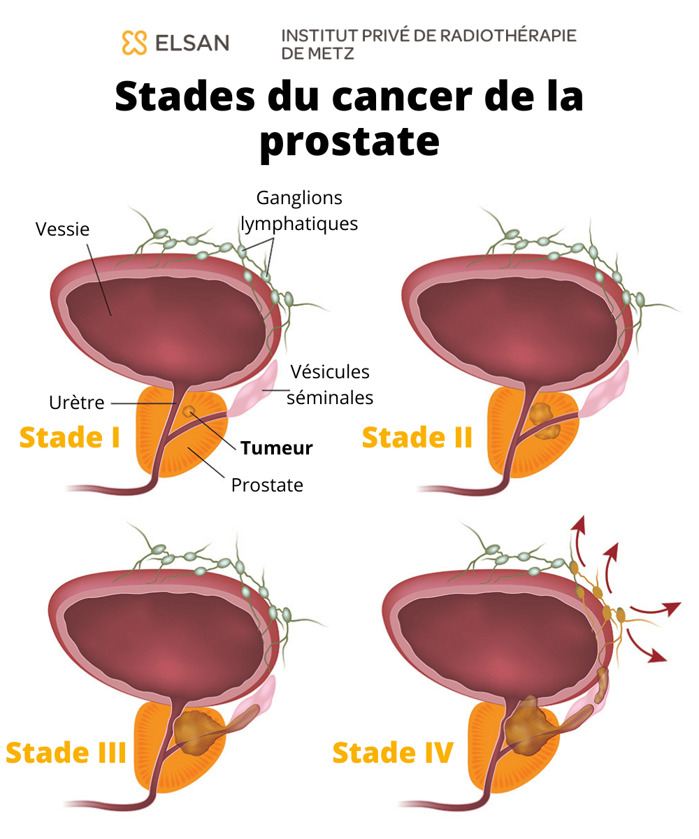 Cancer prostate métastatique : Stades et traitement