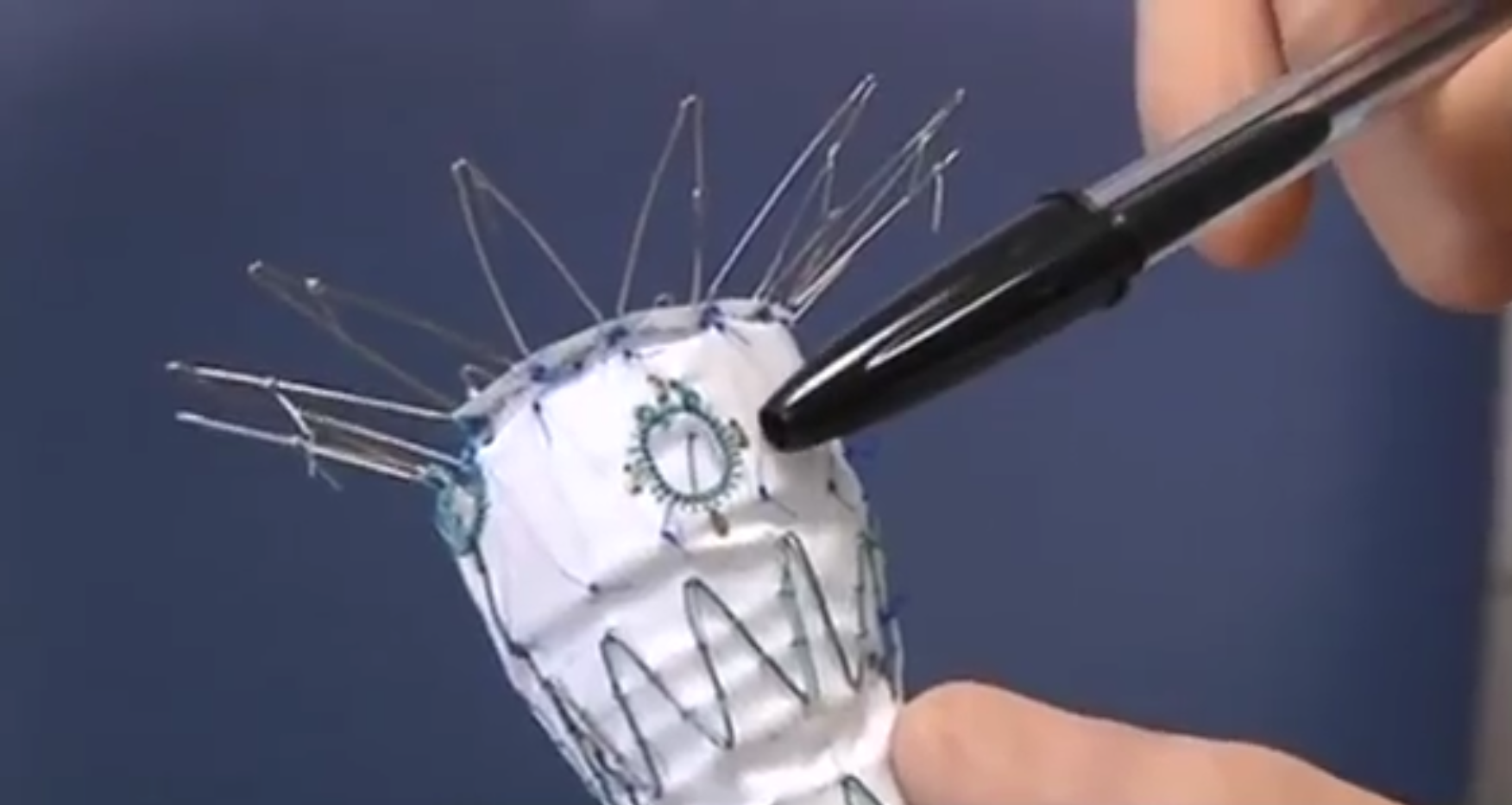 Une première implantation d’endoprothèse aortique trifenêtrée a été