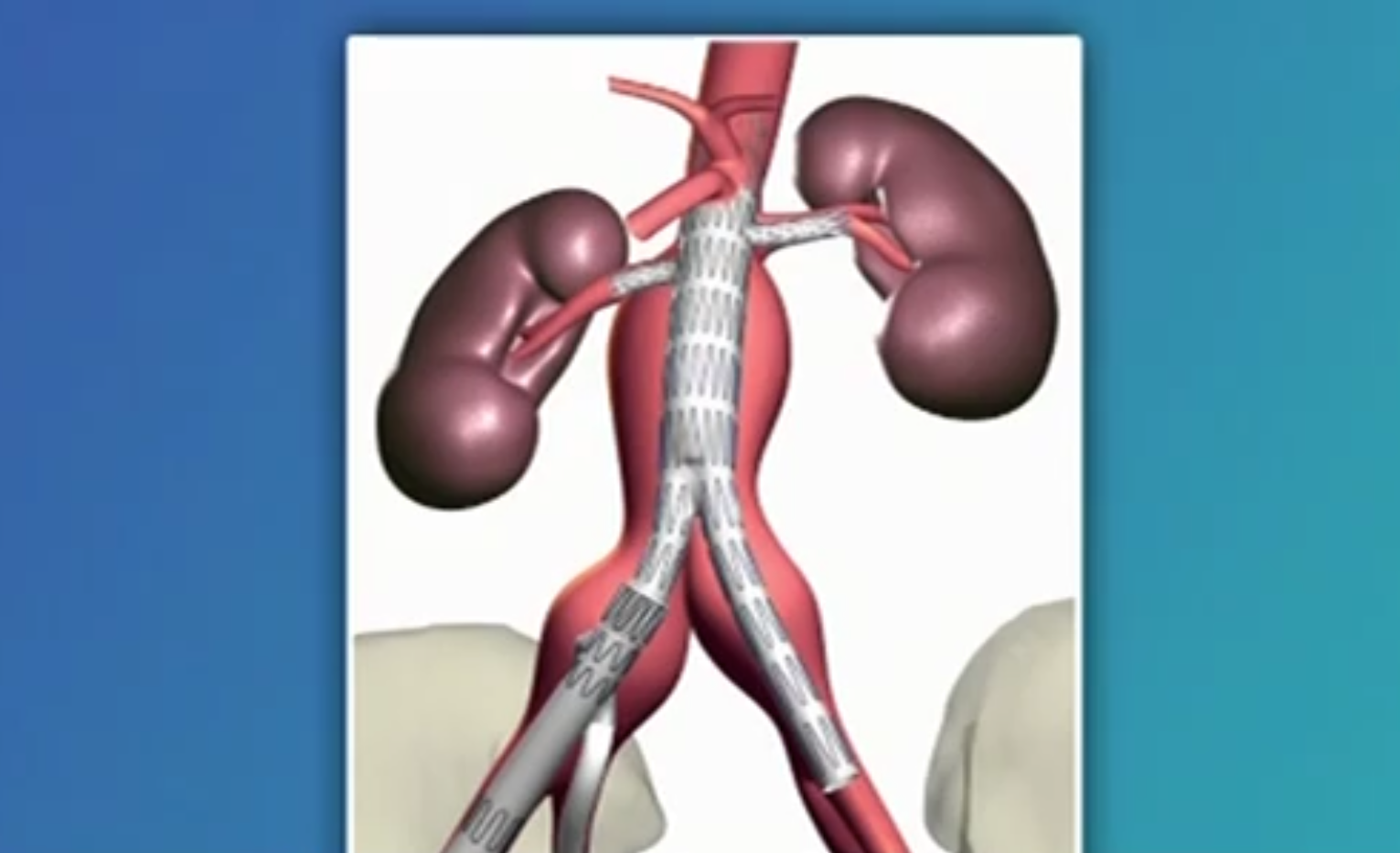 Une première implantation d’endoprothèse aortique trifenêtrée a été