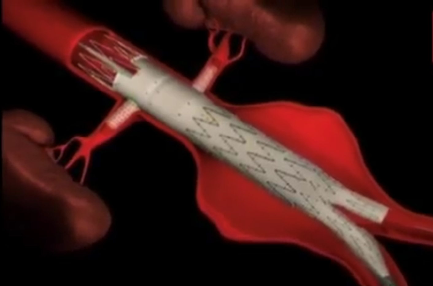 Une première implantation d’endoprothèse aortique trifenêtrée a été réalisée à la Polyclinique