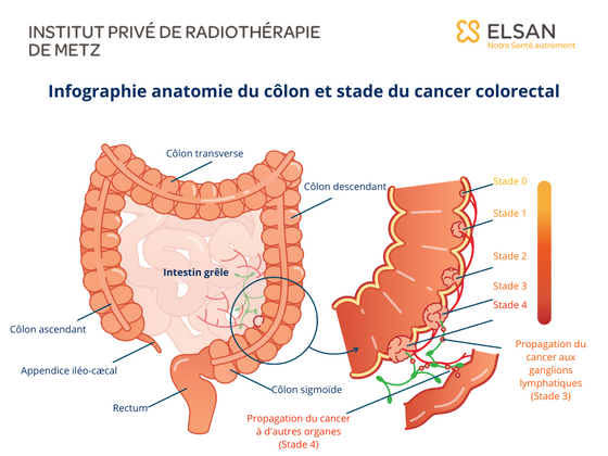 Cancer du colon stade 4, 3, 2, 1. Traitement et symptomes