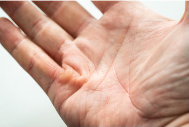 Petite boule dans la paume de la main : est-ce la maladie de