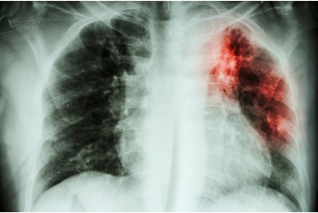 Image de poumons possiblement atteints par le bacille de la tuberculose.