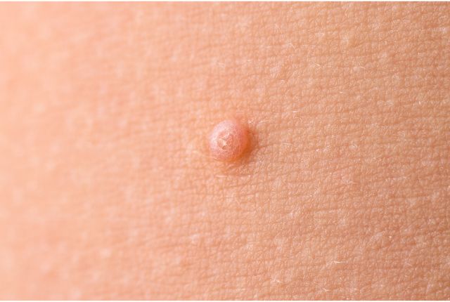 Molluscum contagiosum