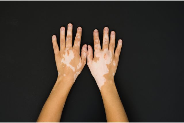 vitiligo