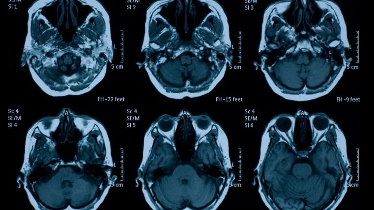IRM cérébrale : série d'images de cerveaux.