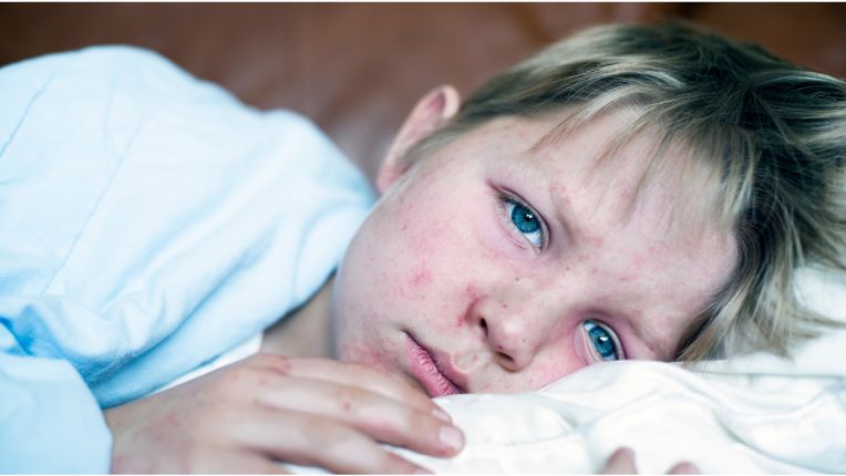 Jeune garçon malade dans son lit, atteint de rougeole.