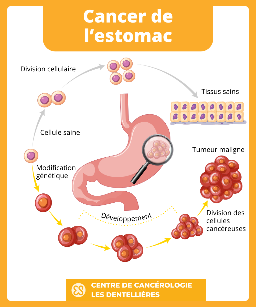 Développement du cancer de l'estomac