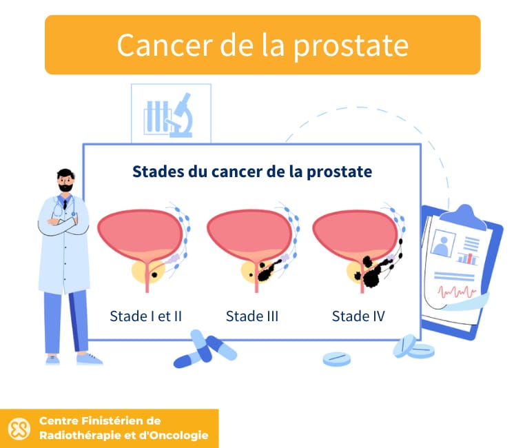 Différents stades du cancer de la prostate