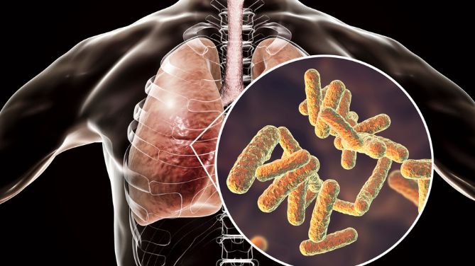 Klebsiella pneumoniae : bactérie résistante des poumons et voies urinaires : image de Klebsiella pneumoniae et de poumons d'un homme.