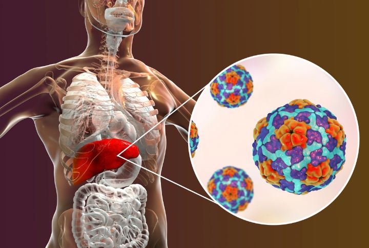 Hépatite B - visuel représentant un foie malade infecté par le VHE (hépatite B) - Elsan