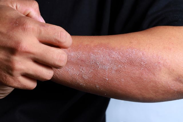 eczema nerveux chez un adulte