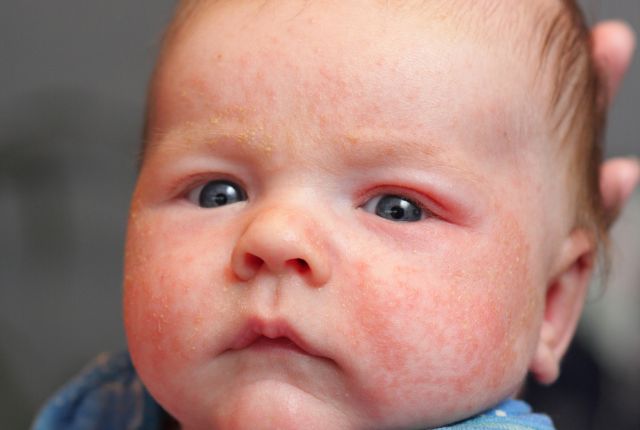 dermatite de stress chez l'enfant