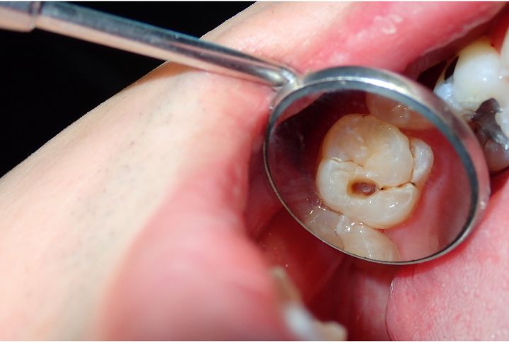 Carie dentaire : gros plan sur une dent creusée avec une tache sombre.