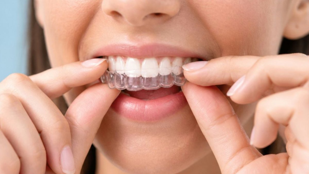 India’s 2026 Clear Aligner Prices Revealed