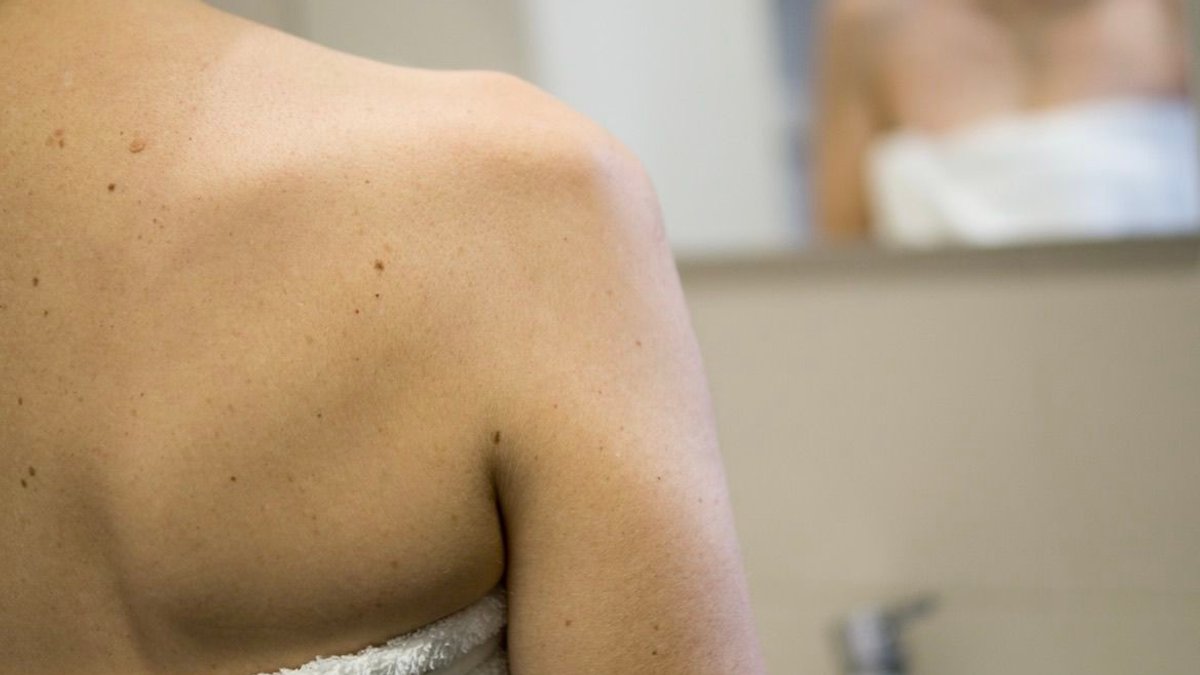 Early Skin Exams Reveal Melanoma Before It Spreads