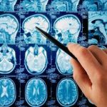 Good Brain, Bad Brain: Parkinson's Disease