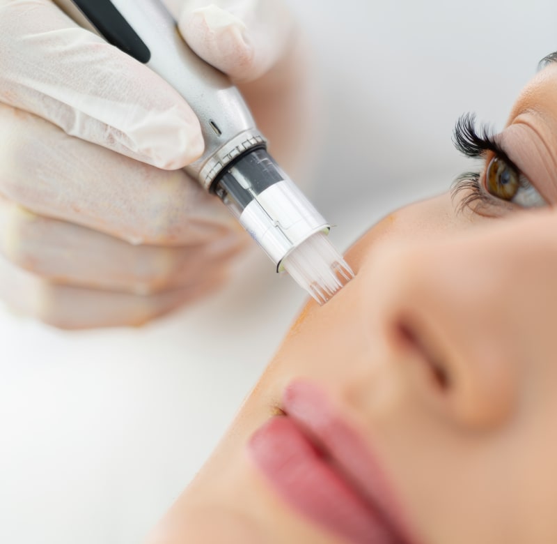 Microneedling