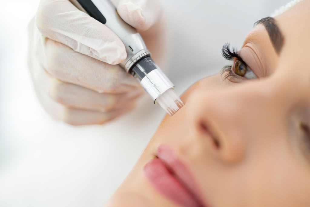 Microneedling