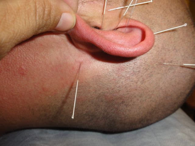 acupuntura en oreja