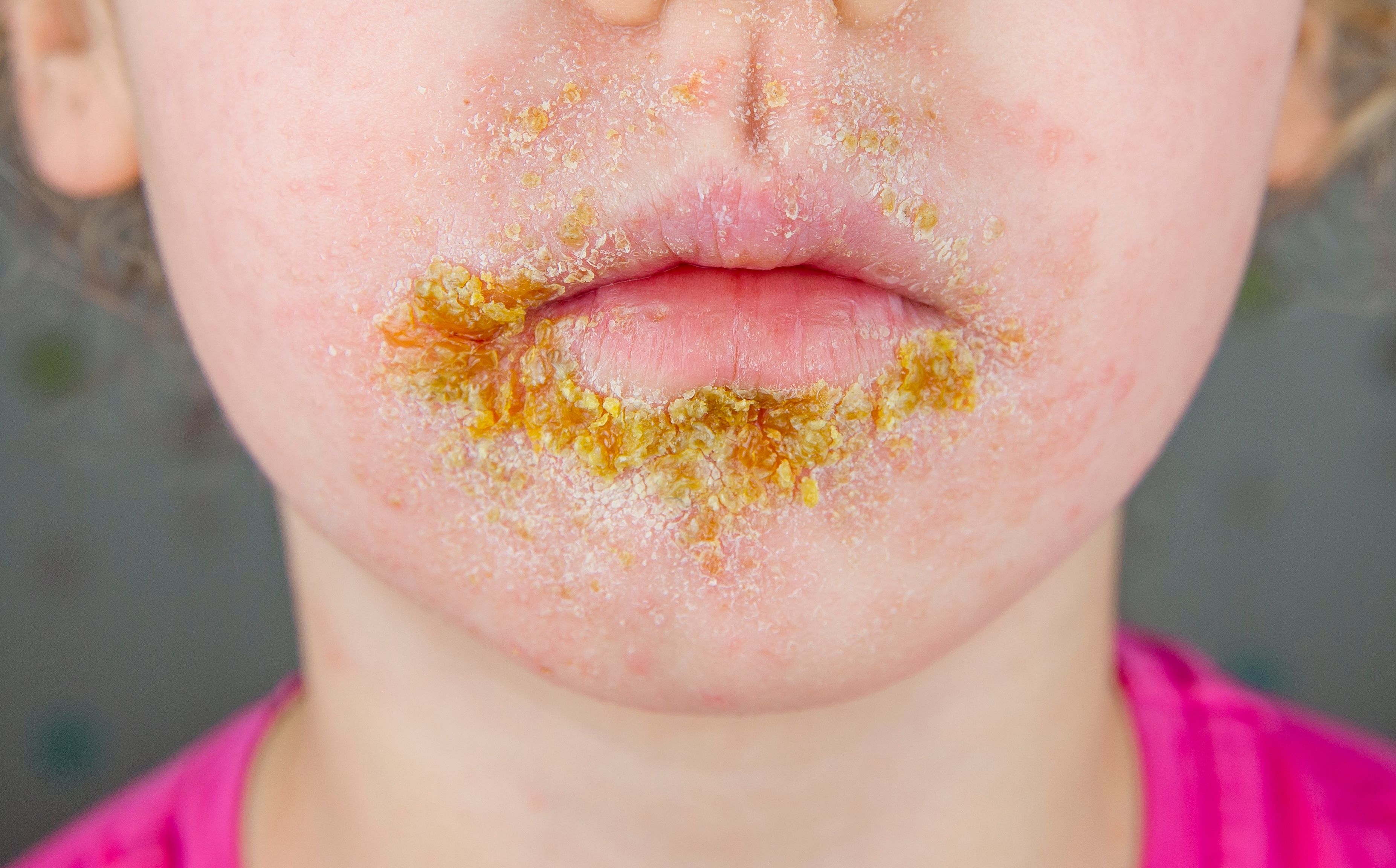 Impetigo e vestibulite: como evitar? Impetigo e vestibulite: como evitar?