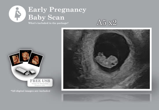 Early Pregnancy scan, Promotional baby scan, Private baby scan, Gateshead baby scan