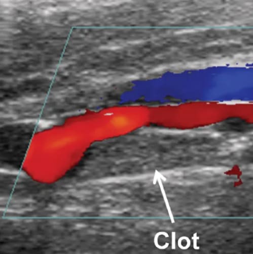 DVT - Deep Vein Thrombosis | Numi Scan East London | Gender scans  | Early pregnancy scan | Private baby scan