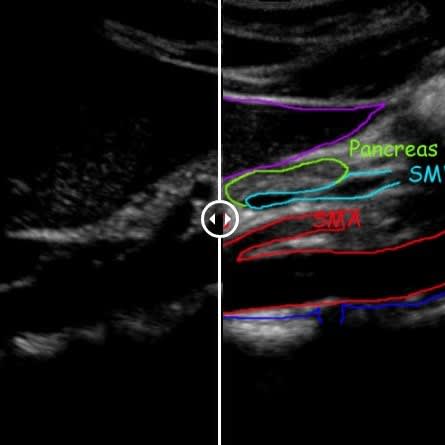 AAA - Abdominal Aortic Aneurysm Screening