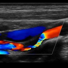 Stroke Screening - Carotid Arteries