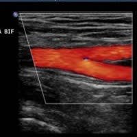 PAD - Peripheral Arterial Disease - Leg