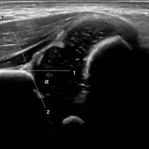 Paediatric Hip Ultrasound