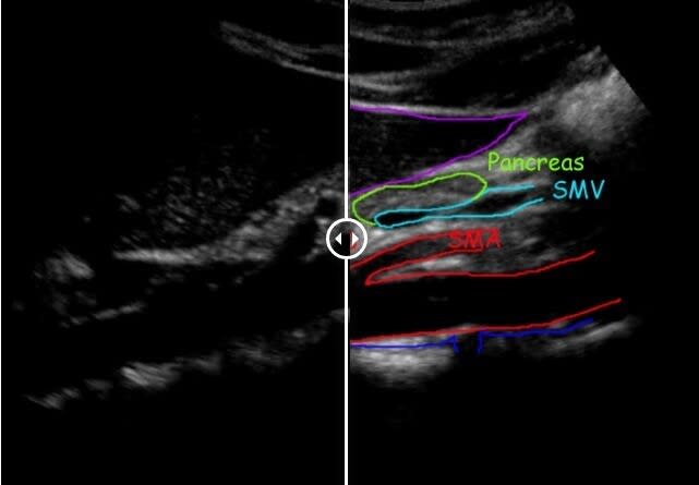 AAA - Abdominal Aortic Aneurysm Screening