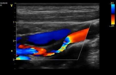 Stroke Screening - Carotid Arteries