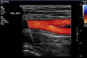 PAD - Peripheral Arterial Disease - Leg