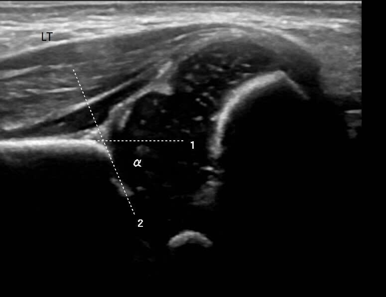 Paediatric Hip Ultrasound