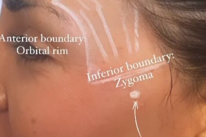 Tear Trough +Temples