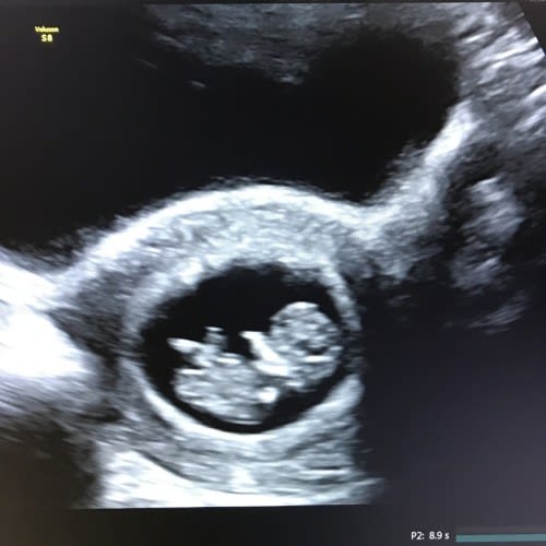 Early Pregnancy Dating Scan Numi Scan Gender Scan Muswell Hill